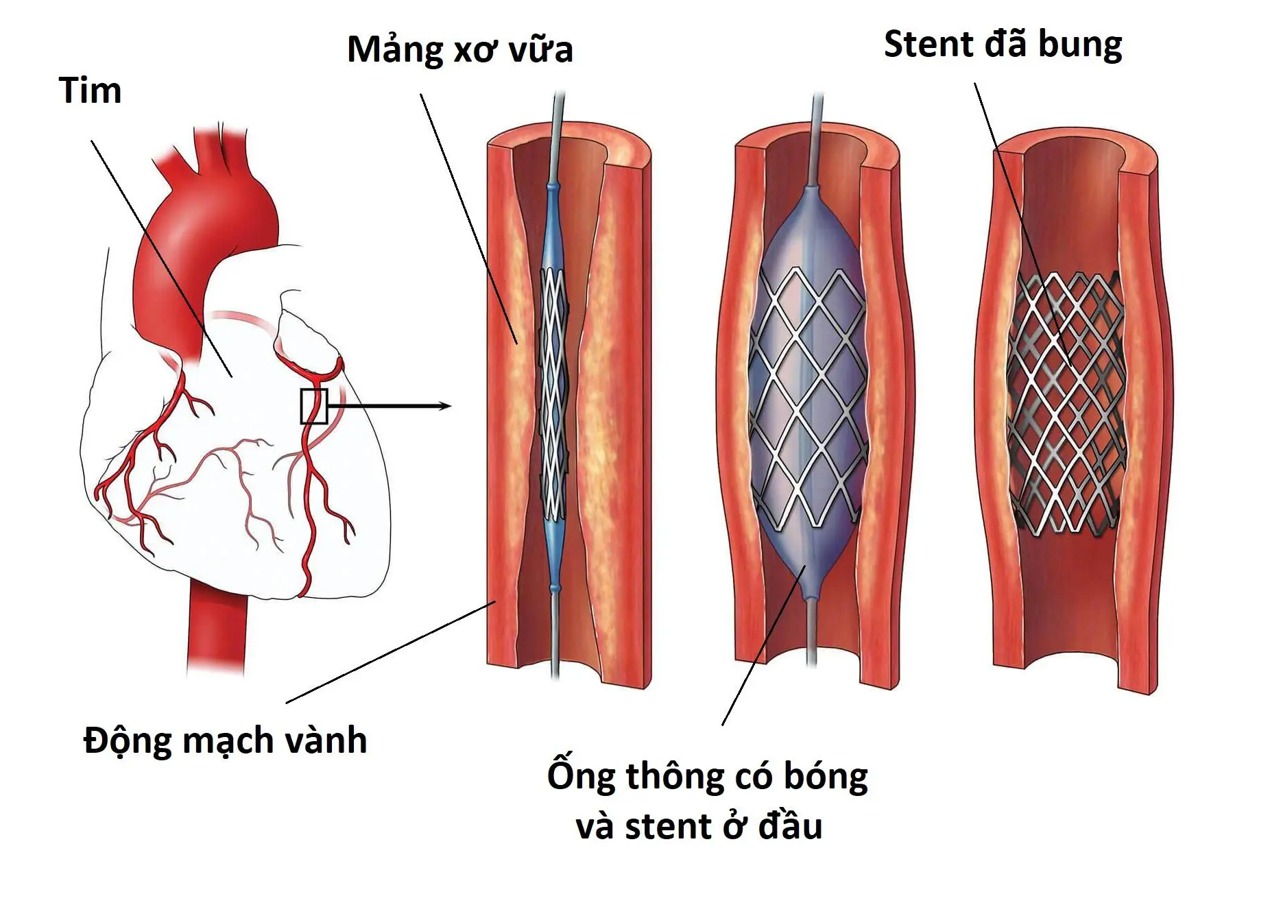 Đặt stent điều trị bệnh mạch vành thì hiệu quả được bao lâu?